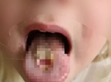 Criança descama língua com bala ácida; especialista compara com queimadura com fogo