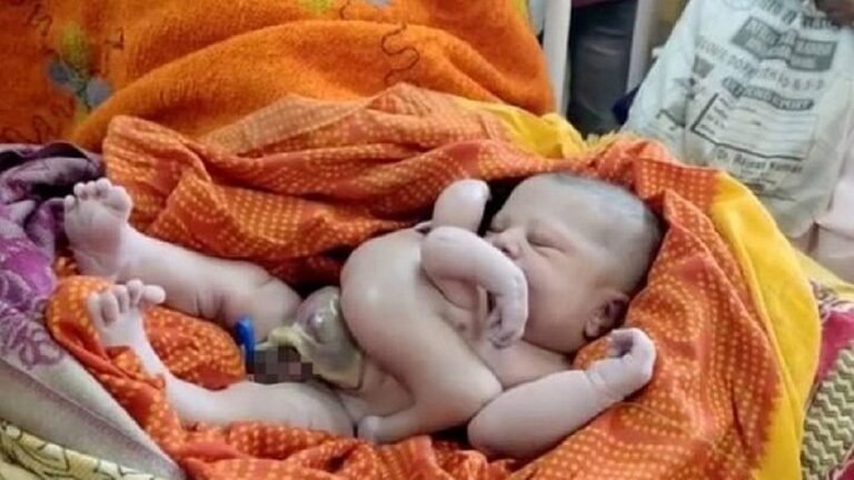 Bebê nascido com quatro braços e quatro pernas é tratado como divindade na Índia