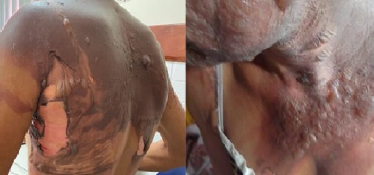 Mulher é queimada pelo companheiro com água fervente no interior da Bahia